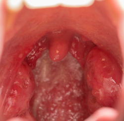 calcium stones deep in throat