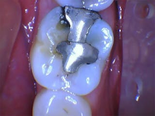 The problem with large metal (amalgam) fillings — Nova Smiles