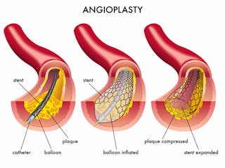 Angioplasty Jeong