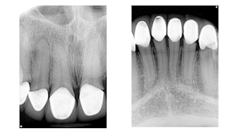 Dodging The Dreaded Dry Socket Tips On Preventing This Painful