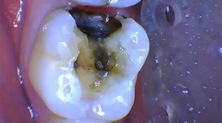 Changing The Patient Experience Using A Co 2 Laser To Remove An