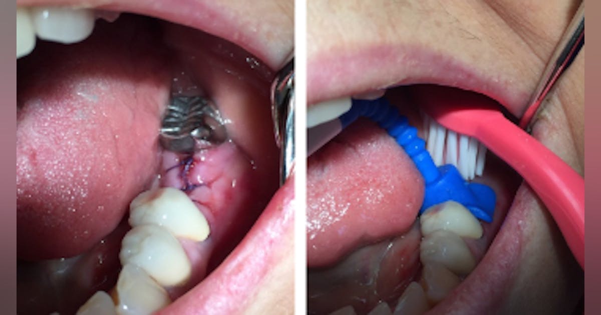 What about postsurgical home care? Tools to improve success | Dentistry IQ