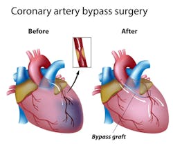 Coronary Bypass Jeong Coronary Bypass Jeong
