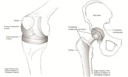 Joint Replacement Jeong Joint Replacement Jeong