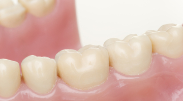 Content Dam Diq Online Articles 2017 06 Interproximal Model Diqthumb