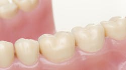 Content Dam Diq Online Articles 2017 06 Interproximal Model Diqthumb Content Dam Diq Online Articles 2017 06 Interproximal Model Diqthumb