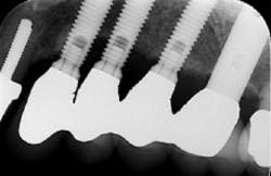 Figure 1: Courtesy of Sally J. Cram, DDS, PC Figure 1: Courtesy of Sally J. Cram, DDS, PC