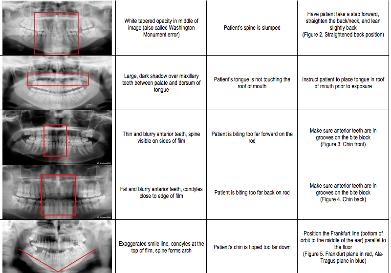 Dental Panoramic X Ray Errors at Kermit Bourdon blog