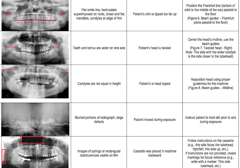 Extraoral panoramic errors a summary for dental assistants Dentistry IQ