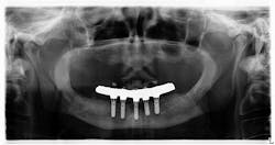 17sept7bcwhatimplant P01 17sept7bcwhatimplant P01