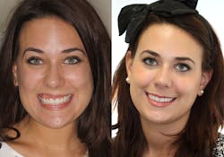 Blessing Facial Injections Part01 Img02 Blessing Facial Injections Part01 Img02