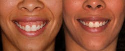 Blessing Facial Injections Part01 Img03 Blessing Facial Injections Part01 Img03