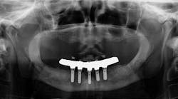 Content Dam Diq Online Articles 2017 09 17sept7bcwhatimplant Thumb Content Dam Diq Online Articles 2017 09 17sept7bcwhatimplant Thumb