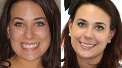 Content Dam Diq Online Articles 2017 09 Blessing Facial Injections Part01 Diqthumb Content Dam Diq Online Articles 2017 09 Blessing Facial Injections Part01 Diqthumb