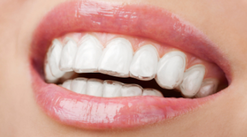 Invisalign's relationship | Dentistry IQ