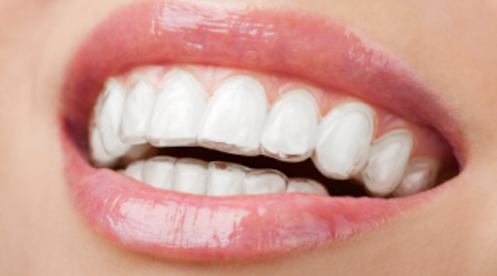 Clear aligner therapy: An esthetic approach to total patient care |  DentistryIQ