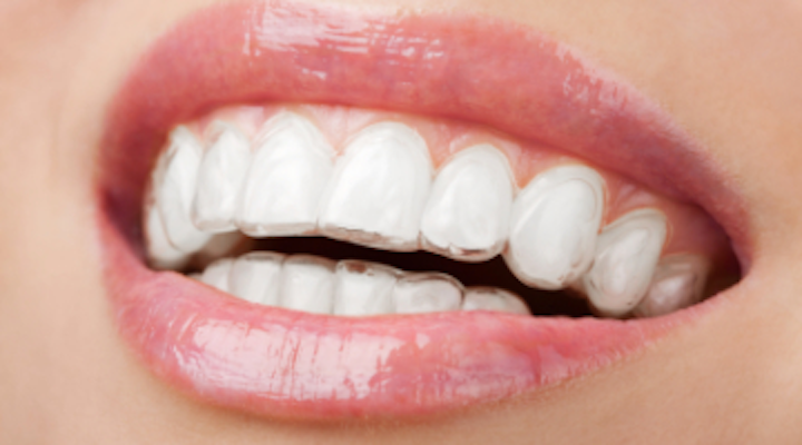 Clear Aligner Therapy An Esthetic Approach To Total Patient Care Dentistryiq