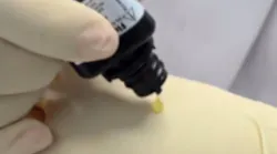 Content Dam Diq Online Articles 2017 09 Olson Fluoride Varnish Glove Diqthumb