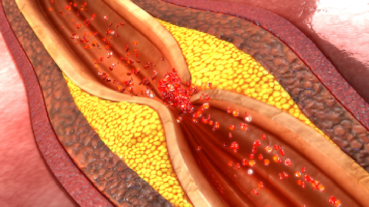 Content Dam Diq Online Articles 2017 10 Atherosclerosis Dreamstime Thumbnail