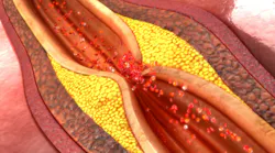 Content Dam Diq Online Articles 2017 10 Atherosclerosis Dreamstime Thumbnail