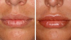 Content Dam Diq Online Articles 2017 10 Shaw Lip Injections Diqthumb Final Final Content Dam Diq Online Articles 2017 10 Shaw Lip Injections Diqthumb Final Final