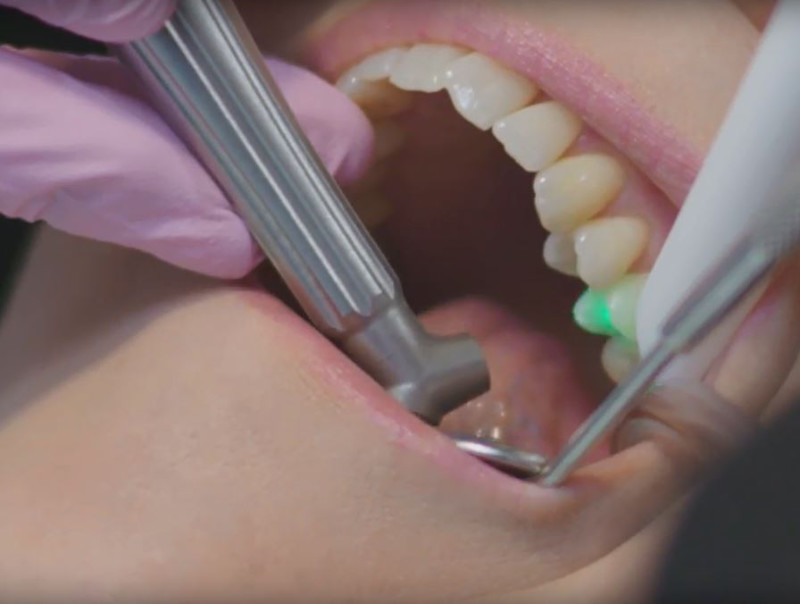 Laser dentistry: A patient's perspective on pain-free treatment | DentistryIQ Laser dentistry: A patient's perspective on pain-free treatment | DentistryIQ