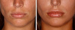 Shaw Lip Injections Case01 Final Final Shaw Lip Injections Case01 Final Final