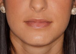 Shaw Lip Injections Figure01 Final Final Shaw Lip Injections Figure01 Final Final