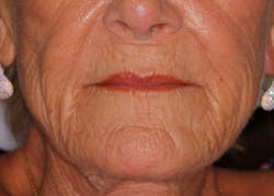 Shaw Lip Injections Figure02 Final Final Shaw Lip Injections Figure02 Final Final