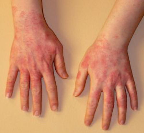 rubber glove allergy