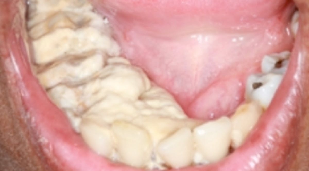 Heavy tartar deals removal