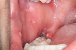 retromolar trigone swollen