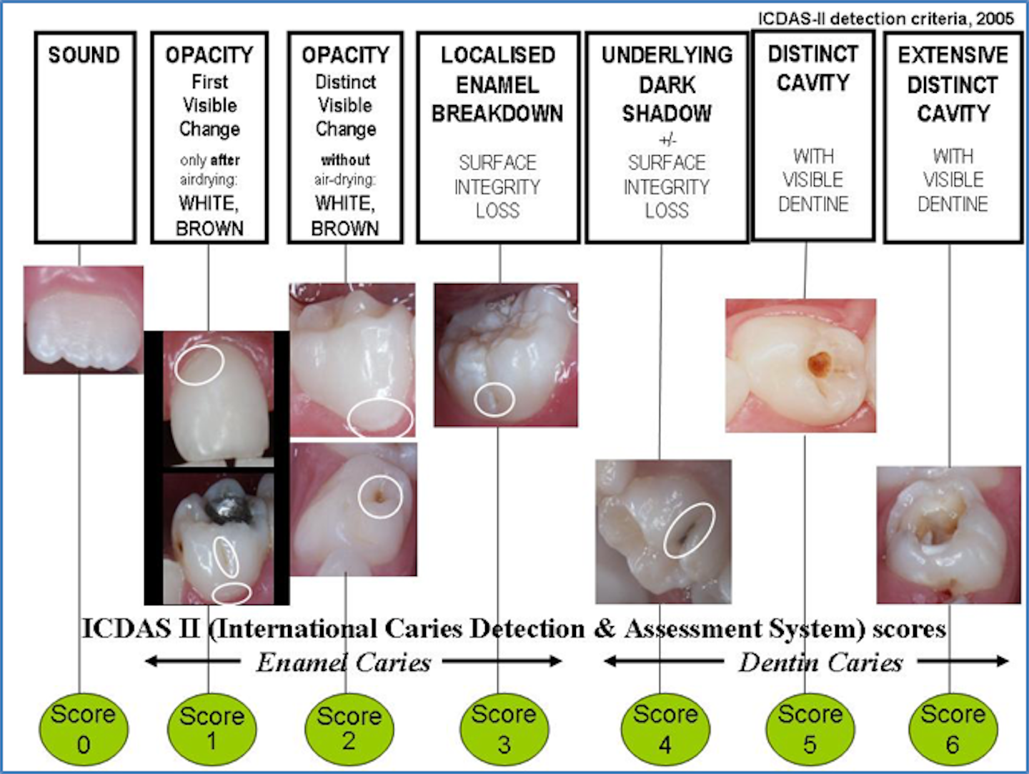 Caries: Tools for enhancing the prevention and management of a common ...