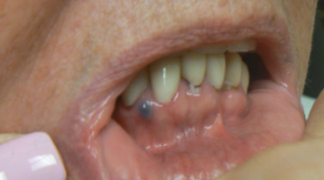 Breakthrough Clinical Oral Pathology Case No 36 Dentistry Iq