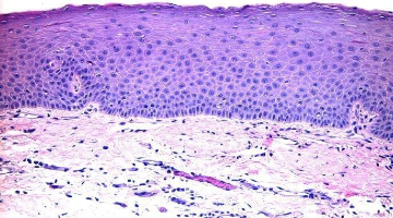 periapical abscess histology