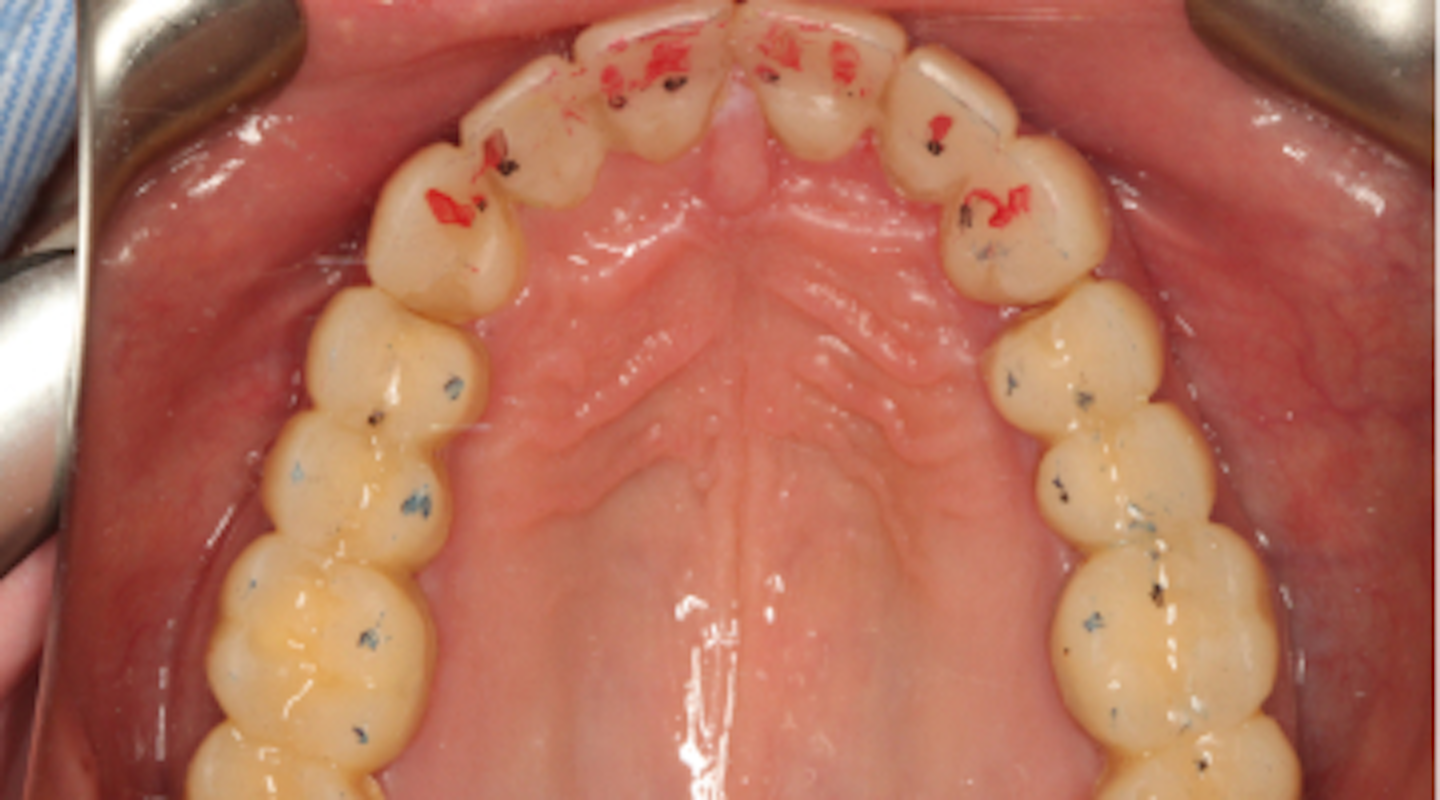 How to treat dental patients who don't know they have occlusal