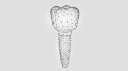 Content Dam Diq Online Articles 2018 07 Dental Implant Sales Tools Diqthumb