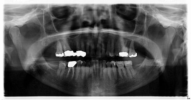 Figure 1: Panoramic radiograph shows radiopaque mass on left side, just anterior to the angle of the mandible