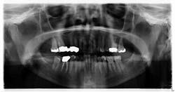 Figure 1: Panoramic radiograph shows radiopaque mass on left side, just anterior to the angle of the mandible Figure 1: Panoramic radiograph shows radiopaque mass on left side, just anterior to the angle of the mandible