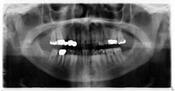Figure 2: Panoramic radiograph taken six years prior shows the same lesion, although somewhat less distinctive Figure 2: Panoramic radiograph taken six years prior shows the same lesion, although somewhat less distinctive