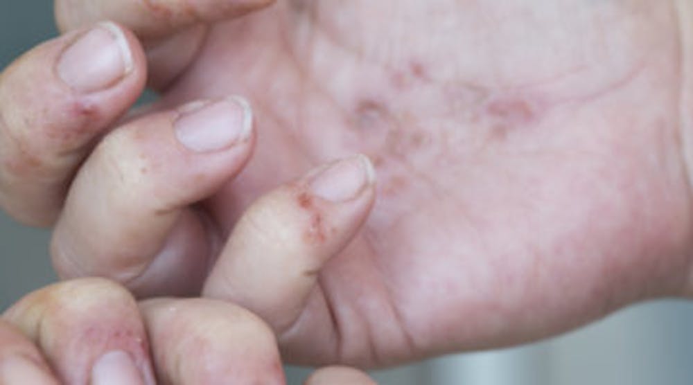 Content Dam Diq Online Articles 2018 08 Dermatitis Hands Auger Diqthumb