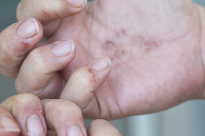 Dermatitis Hands Auger