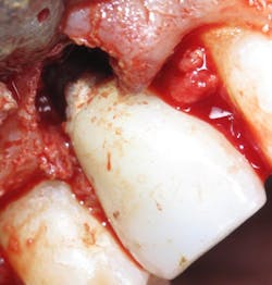 Fortune Wedpnae Implantcement Fig03 Fortune Wedpnae Implantcement Fig03