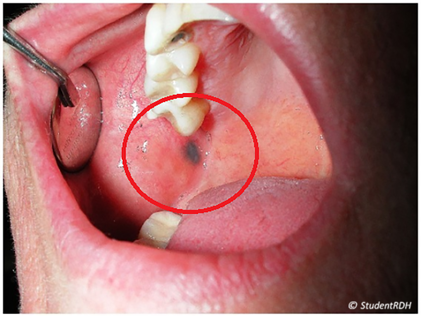 8 steps for documenting oral lesions DentistryIQ