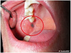 Figure 1: Unknown oral lesion Figure 1: Unknown oral lesion