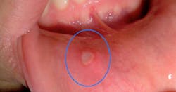 Figure 2: Unknown oral lesion Figure 2: Unknown oral lesion