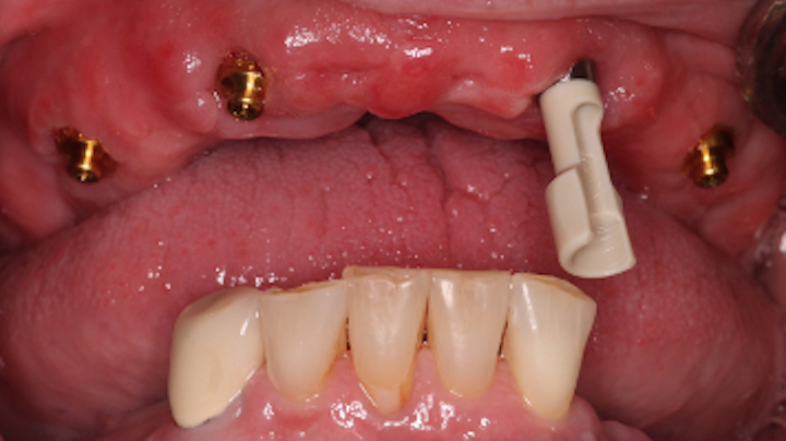 Dds Dentures And Implants Near Me  - Periodontist, Implant Specialist Specializes In Teeth Replacement Procedures.