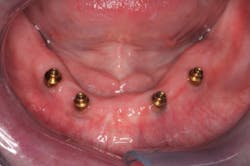 Figure 1: Implants for removable dentures Figure 1: Implants for removable dentures