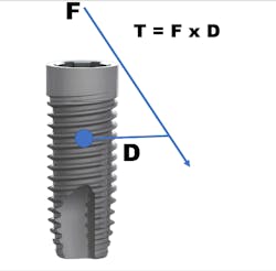 Figure 2: T = F x D (calculating torque on a dental implant)