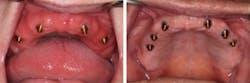 Figure 4: Four versus six implants Figure 4: Four versus six implants